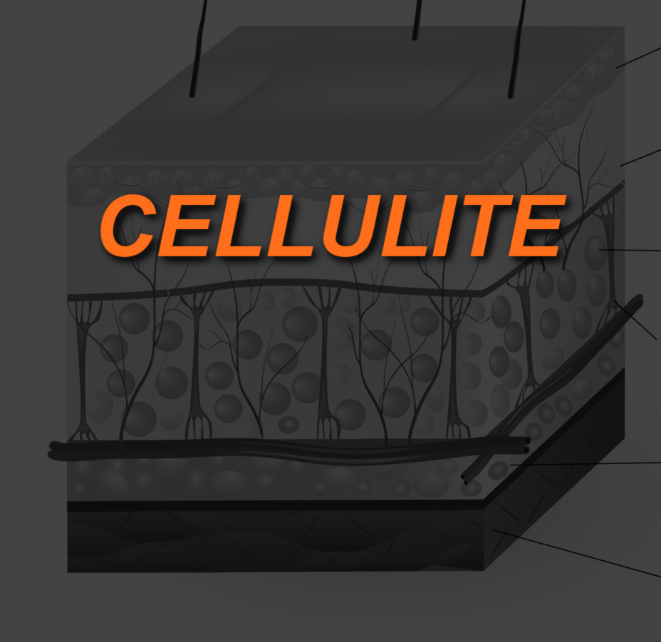 CELLULITE IMAGE